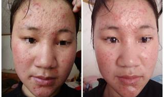 祛痘最好的医院 祛痘最好的医院